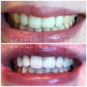 Tanden Bleken Sneek 100% Veilig en Pijnloos | by Brigitte